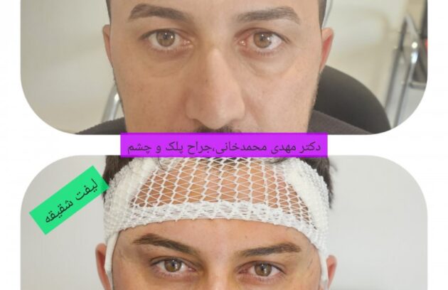 جراحی لیفت شقیقه دکتر مهدی محمدخانی جراح پلک و متخصص چشم عملهای زیبایی چشم شامل انواع عمل های بلفاروپلاستی ، لیفت ابرو ، لیفت شقیقه و لیفت اندوسکوپیک پیشانی و ابرو