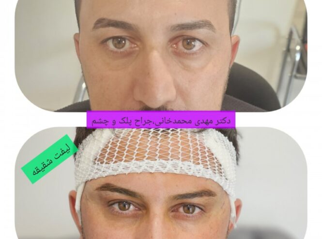 جراحی لیفت شقیقه دکتر مهدی محمدخانی جراح پلک و متخصص چشم عملهای زیبایی چشم شامل انواع عمل های بلفاروپلاستی ، لیفت ابرو ، لیفت شقیقه و لیفت اندوسکوپیک پیشانی و ابرو