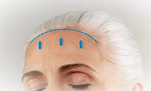 جراحی لیفت پیشانی