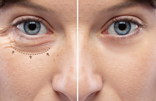 بلفاروپلاستی پلک پایین دکتر مهدی محمدخانی جراح پلک و متخصص چشم عملهای زیبایی چشم شامل انواع عمل های بلفاروپلاستی ، لیفت ابرو ، لیفت شقیقه و لیفت اندوسکوپیک پیشانی و ابرو