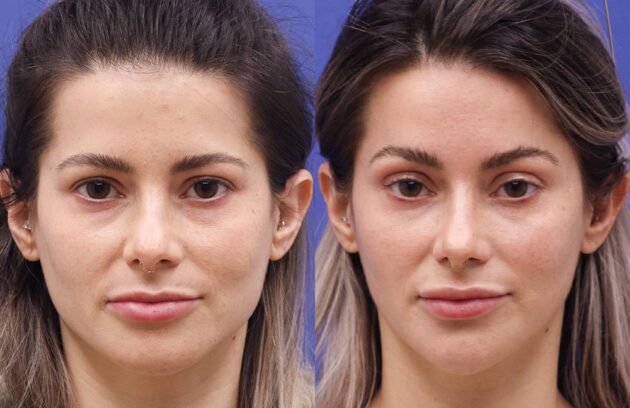 جراحی لیفت ابرو دکتر مهدی محمدخانی جراح پلک و متخصص چشم عملهای زیبایی چشم شامل انواع عمل های بلفاروپلاستی ، لیفت ابرو ، لیفت شقیقه و لیفت اندوسکوپیک پیشانی و ابرو