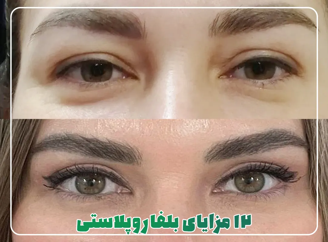 12 مزایای عمل بلفاروپلاستی پلک بالا