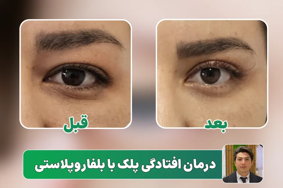 درمان افتادگی پلک با بلفاروپلاستی