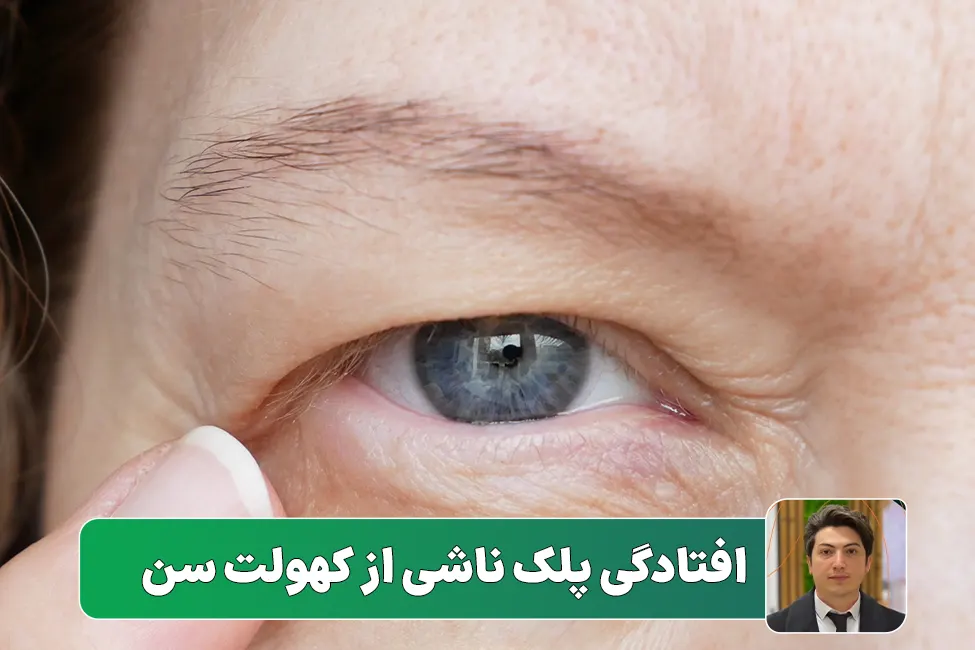 افتادگی پلک با افزایش سن
