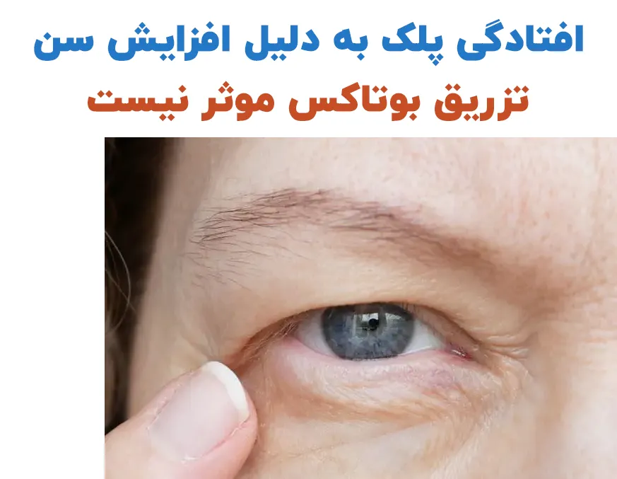 تاثیر بوتاکس در افتادگی ابرو