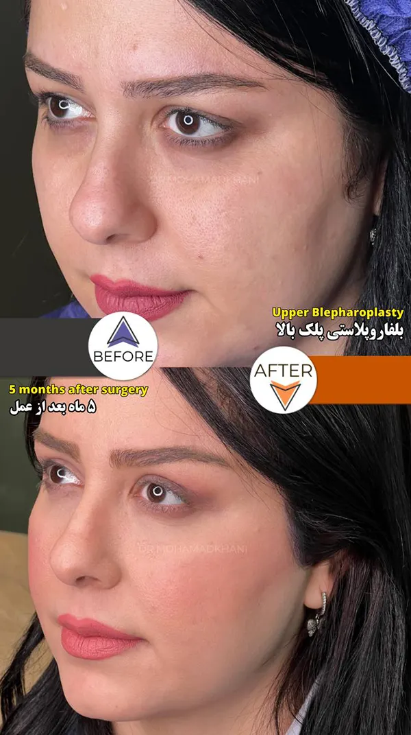 بلفاروپلاستی پلک بالا