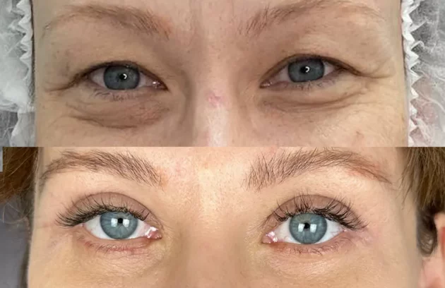 بلفاروپلاستی