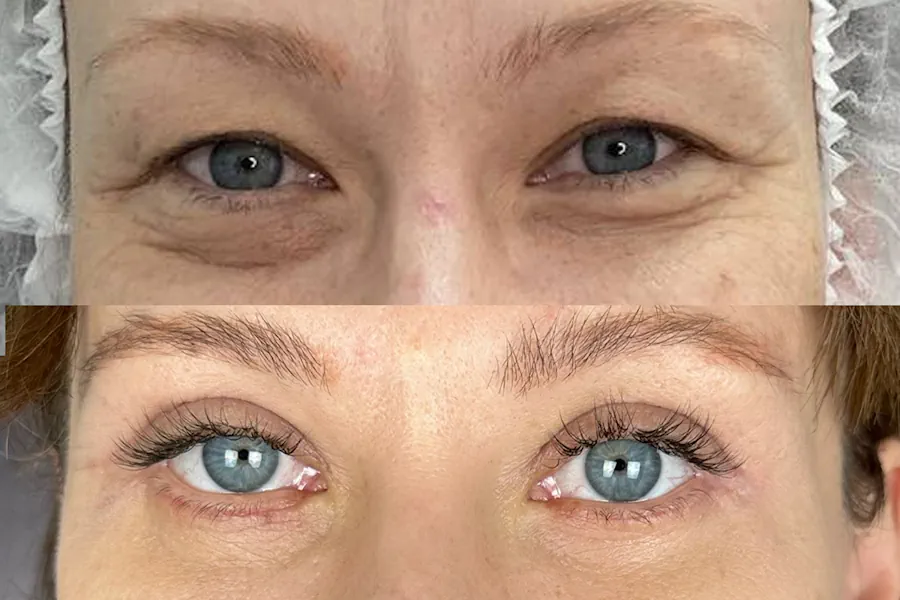 بلفاروپلاستی