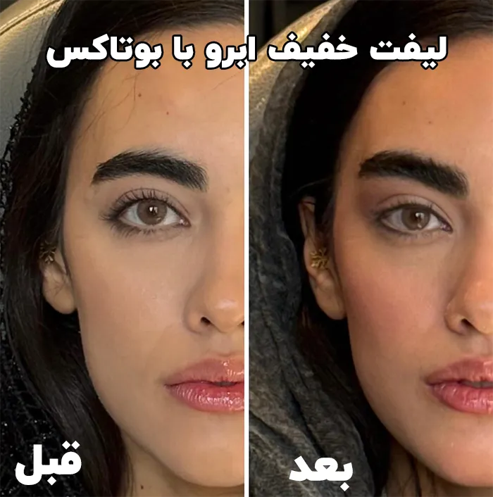 لیفت خفیف ابرو با بوتاکس
