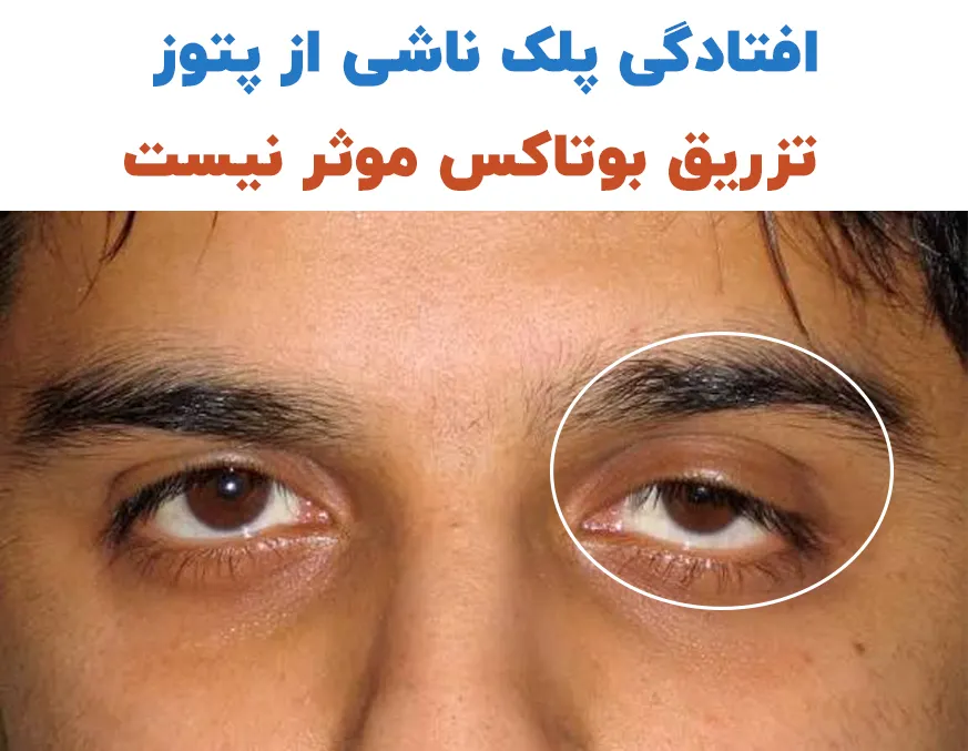 تاثیر بوتاکس روی پتوز