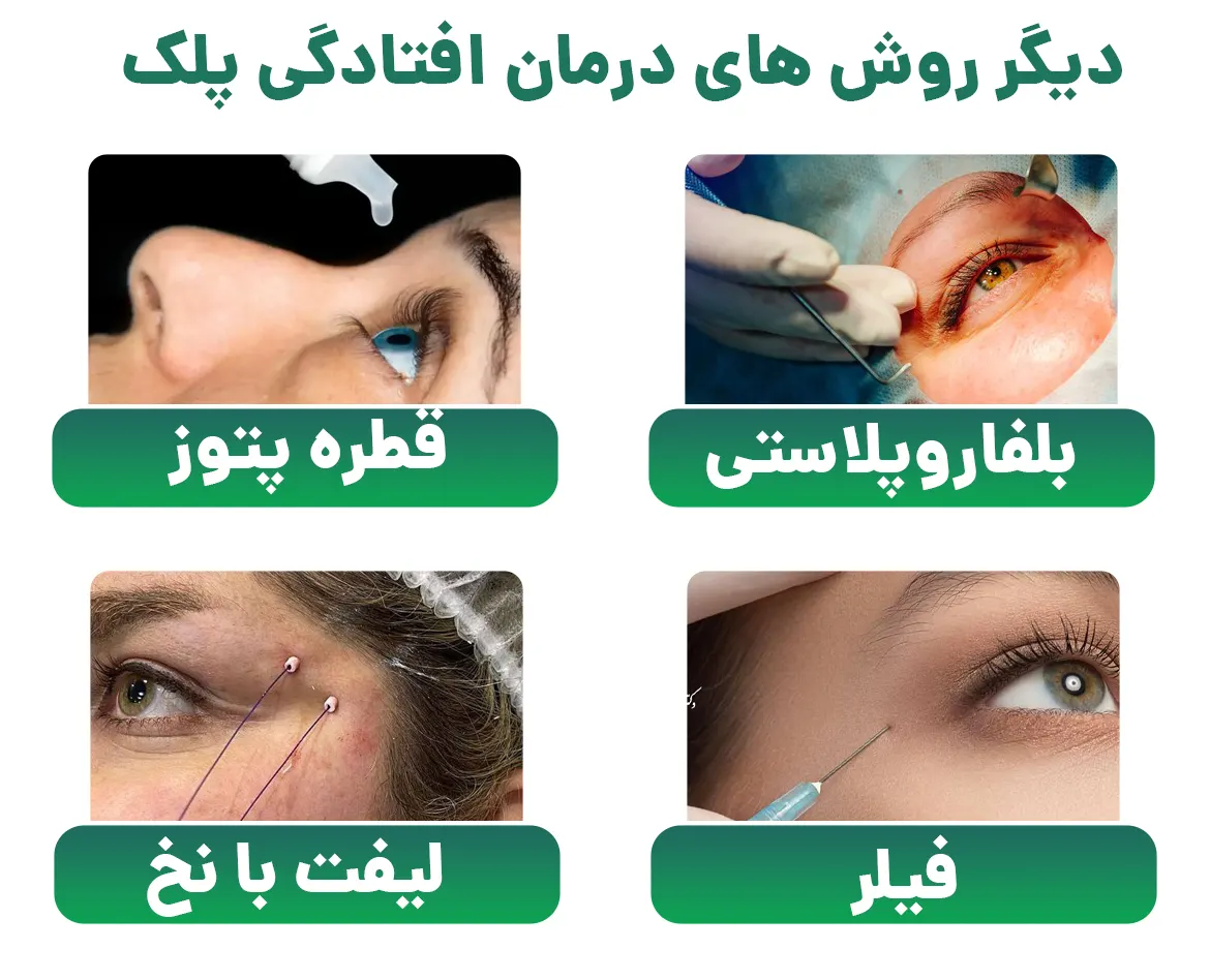 دیگر شیوه های درمان افتادگی پلک