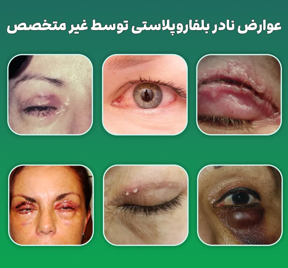 عوارض بلفاروپلاستی