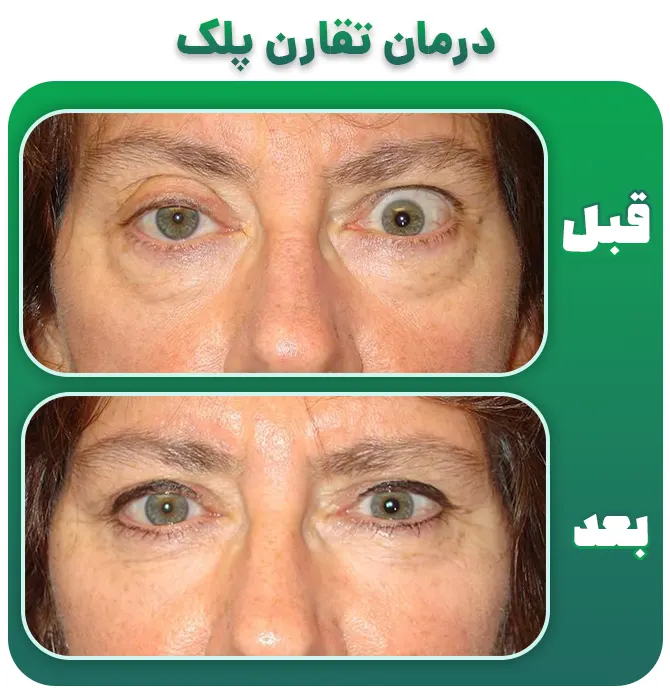 عدم تقارن بعد عمل بلفاروپلاستی