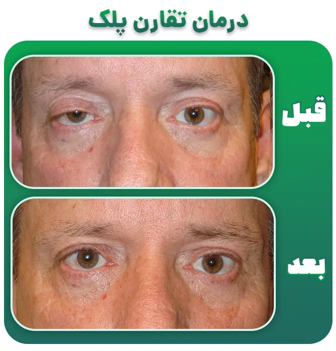درمان عدم تقارن پلک