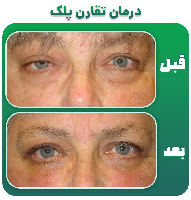 درمان عدم تقارن پلک بالا