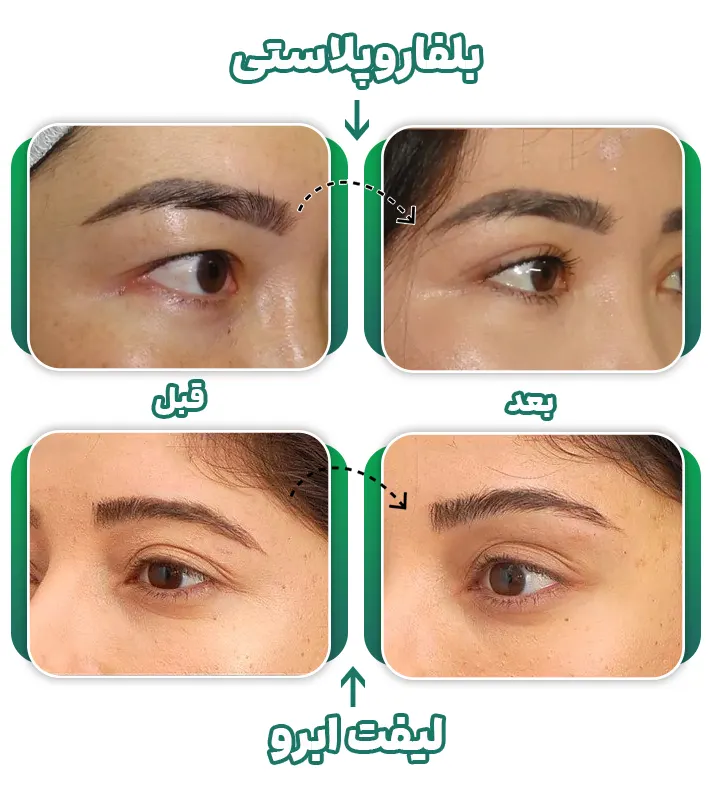 مقایسه بلفاروپلاستی و لیفت ابرو