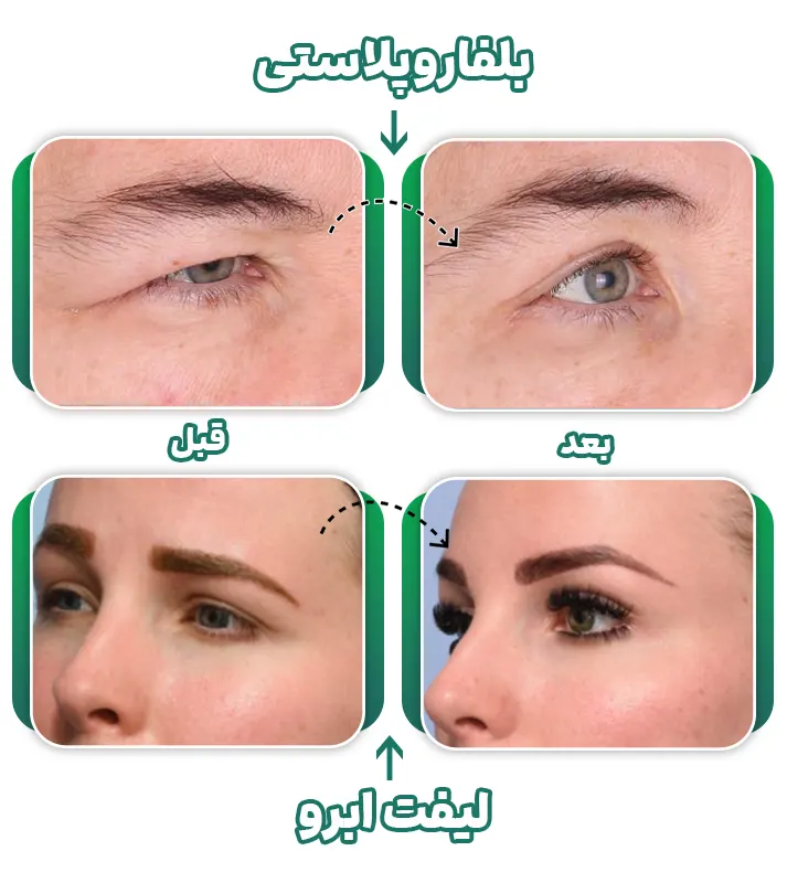 مقایسه بلفاروپلاستی و لیفت ابرو