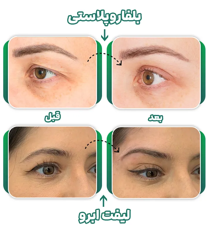 مقایسه بلفاروپلاستی و لیفت ابرو
