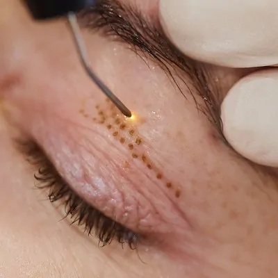 درمان افتادگی پلک با پلاسماجت