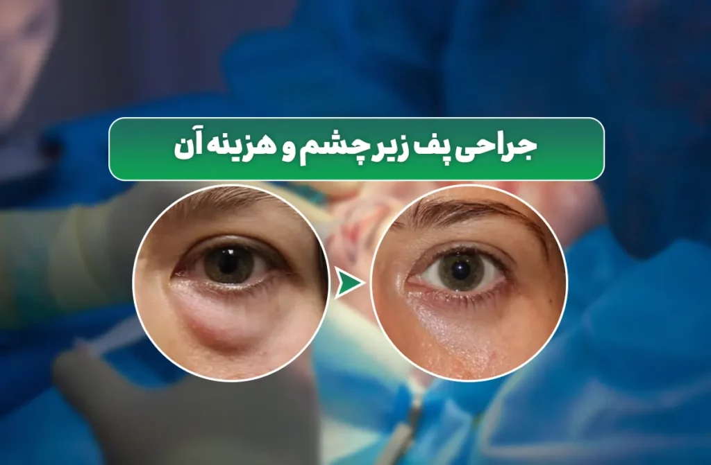 جراحی پف زیر چشم
