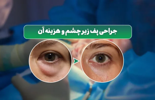 جراحی پف زیر چشم
