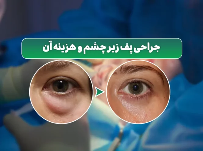 جراحی پف زیر چشم