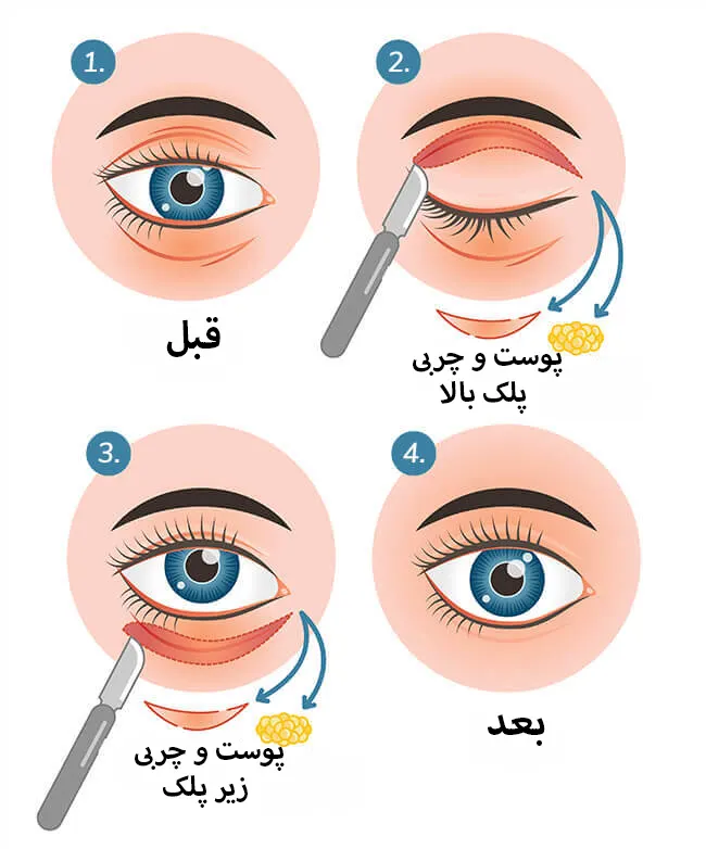 بلفاروپلاستی پلک بالا