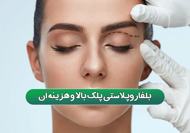 بلفاروپلاستی پلک بالا و هزینه آن