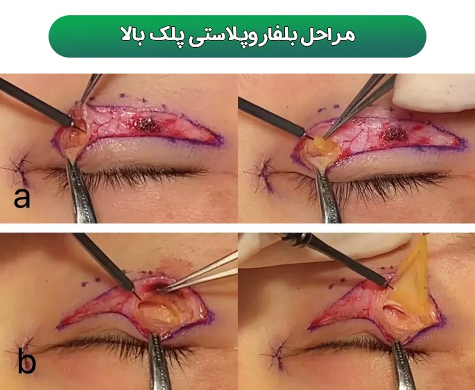 بلفاروپلاستی پلک بالا
