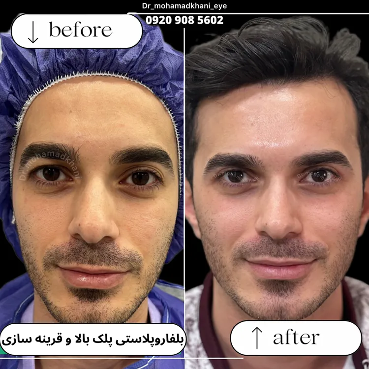 قرینه سازی پلک