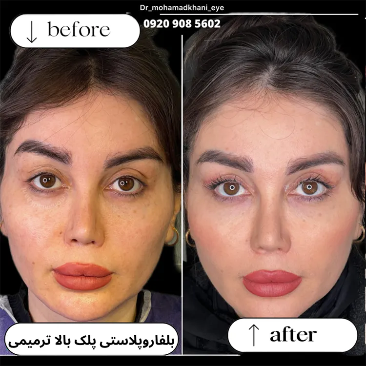 بلفاروپلاستی ترمیمی