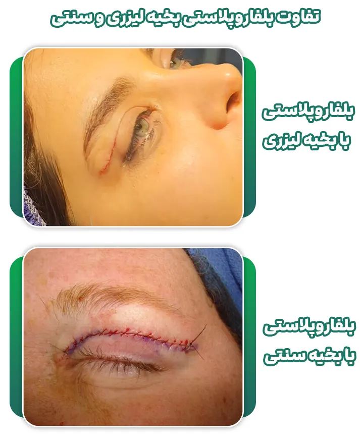 تفاوت بلفاروپلاستی لیزر و بخیه