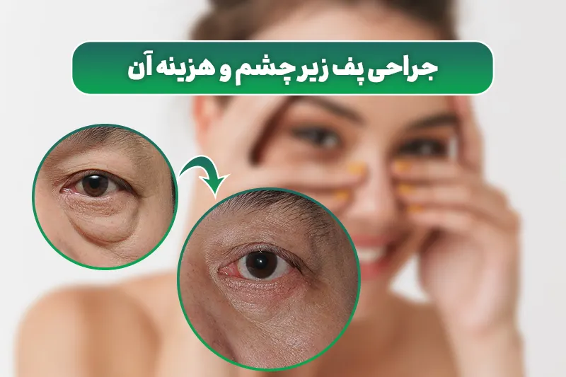 جراحی پف زیر چشم