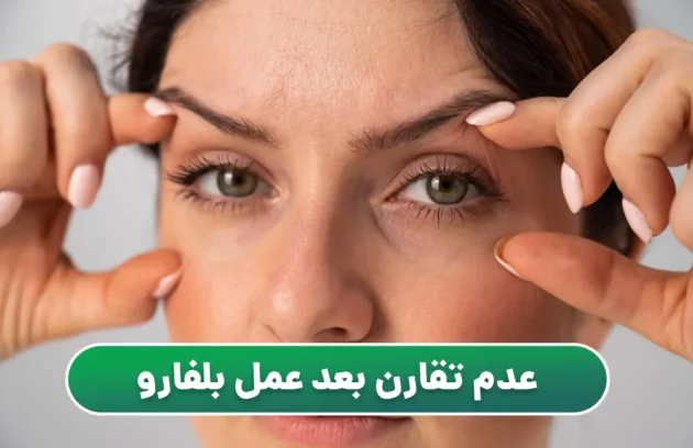 عدم تقارن بعد عمل بلفاروپلاستی