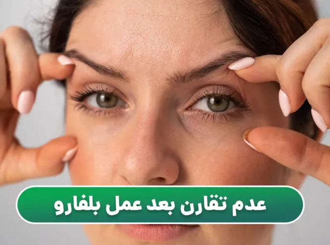 عدم تقارن بعد عمل بلفاروپلاستی
