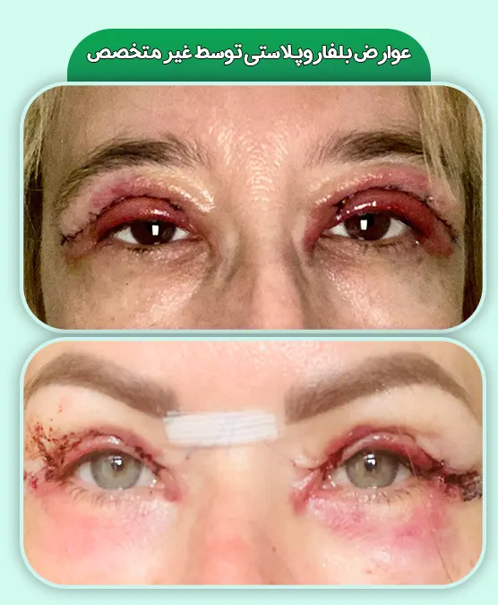 عوارض بلفاروپلاستی توسط غیر متخصص
