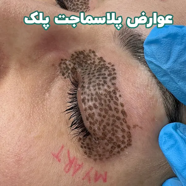 عوارض پلاسماجت پلک