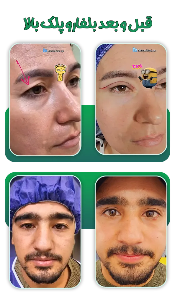 قبل و بعد بلفارو پلک بالا