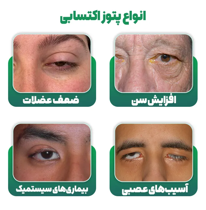 پتوز اکتسابی