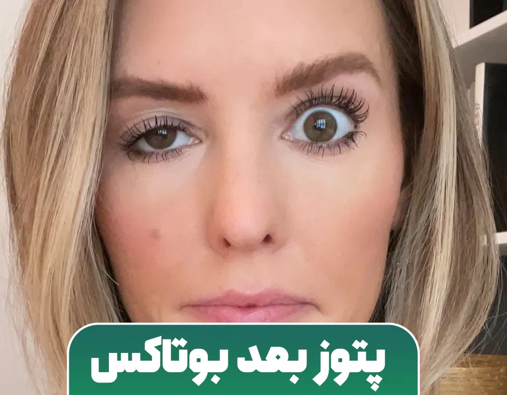 پتوز ناشی از تزریق بوتاکس