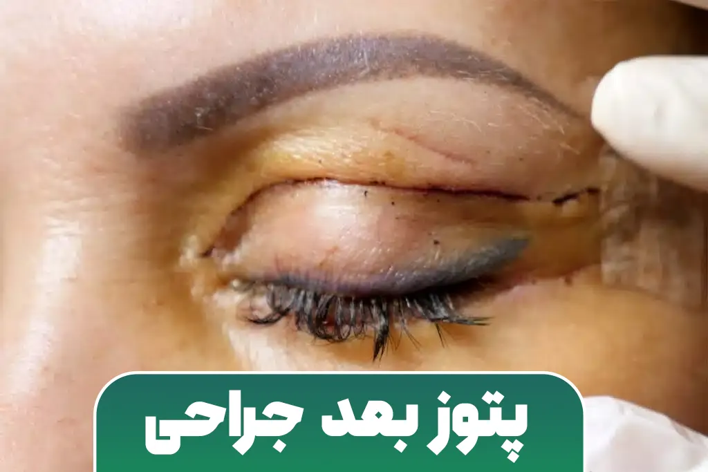 پتوز بعد از جراحی
