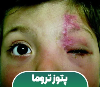 پتوز تروما