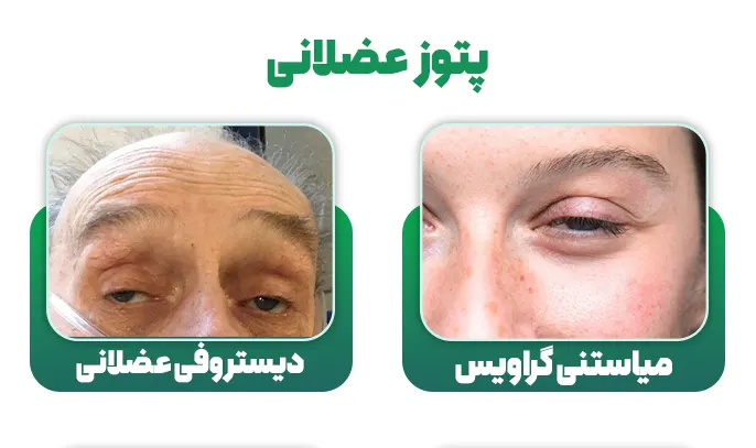 پتوز عضلانی