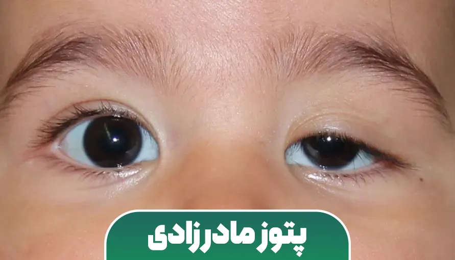 پتوز مادرزادی