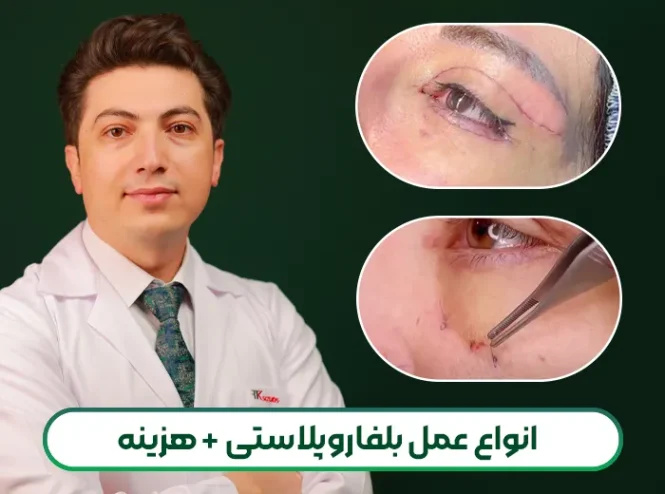 انواع عمل بلفاروپلاستی