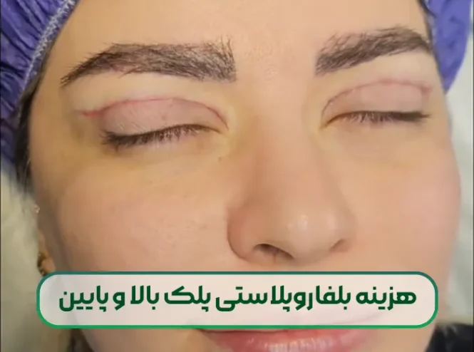 هزینه بلفاروپلاستی پلک بالا و پایین