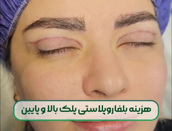 هزینه بلفاروپلاستی پلک بالا و پایین