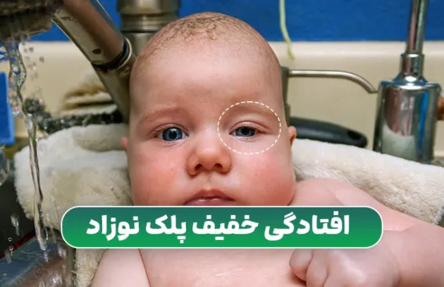 افتادگی خفیف پلک نوزاد