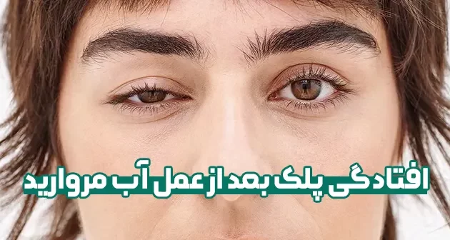 افتادگی پلک بعد از عمل آب مروارید و درمان آن