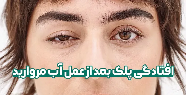 افتادگی پلک بعد از عمل آب مروارید و درمان آن